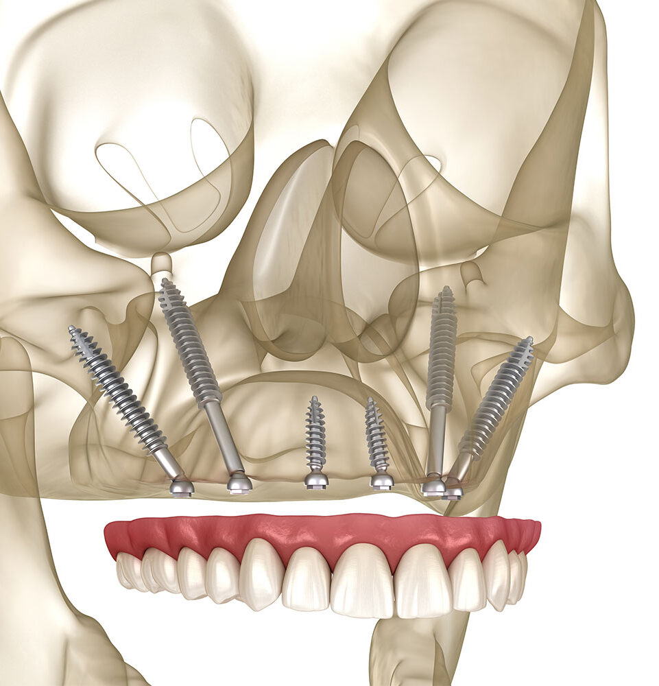 Pterygoid implants