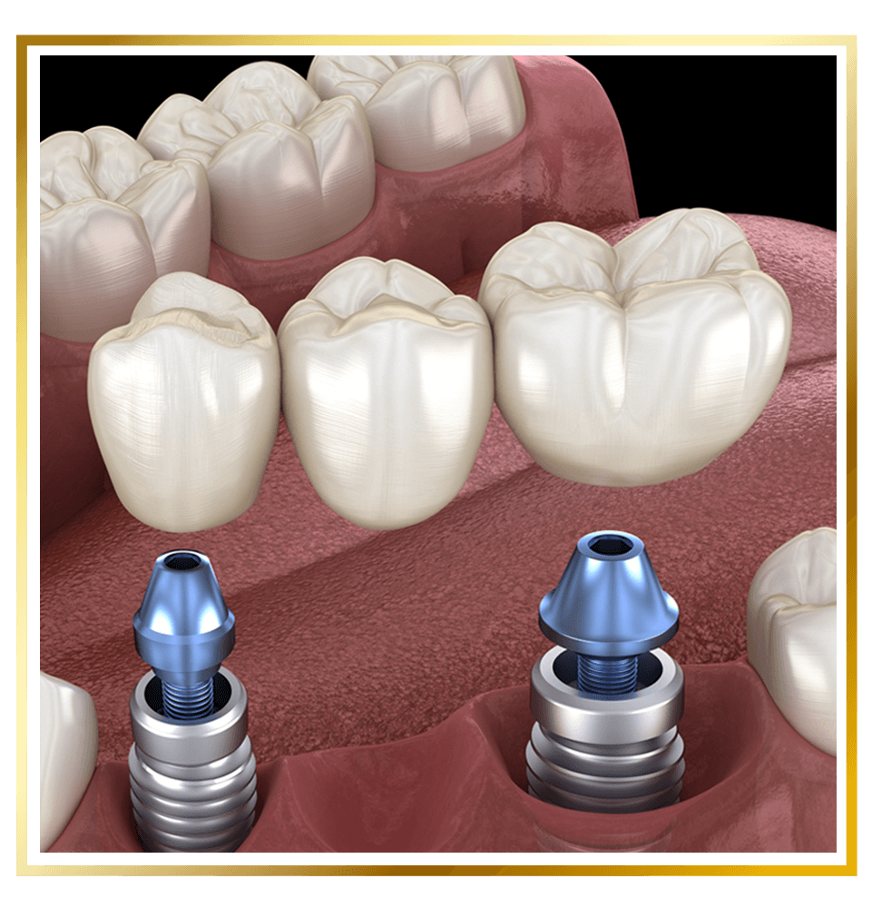 dental bridge