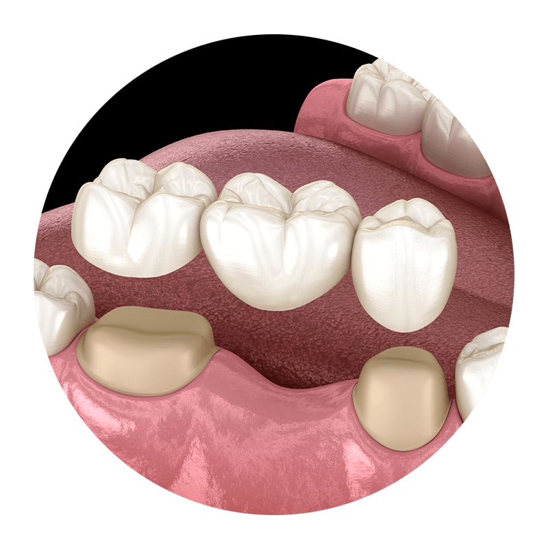 dental bridge 3d model