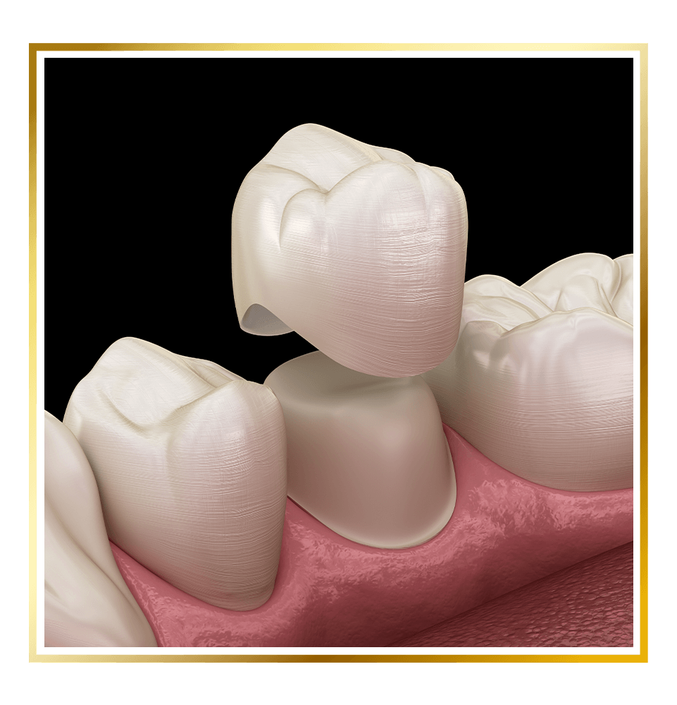 dental crown 3d model