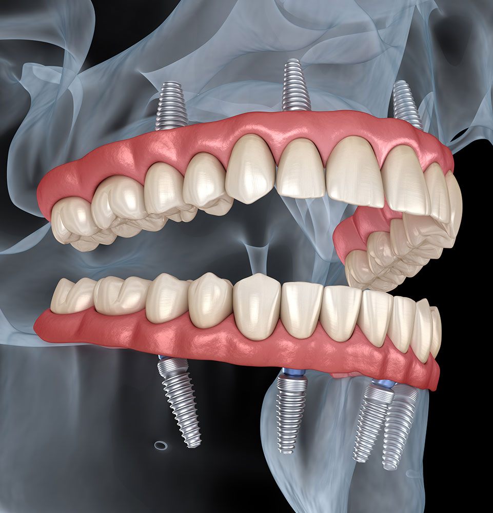 implants being placed