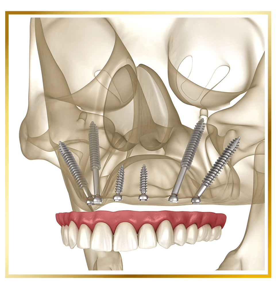 pterygoid 3d