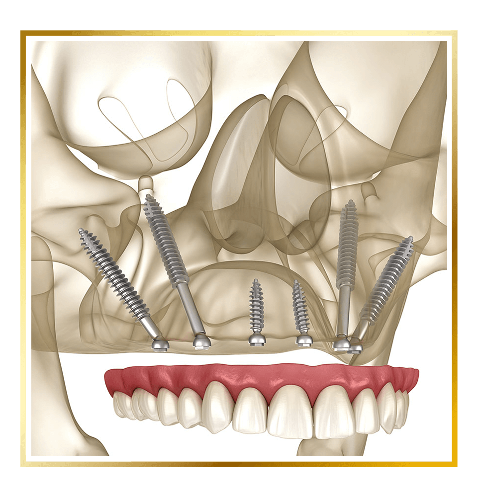 pterygoid implant 3d