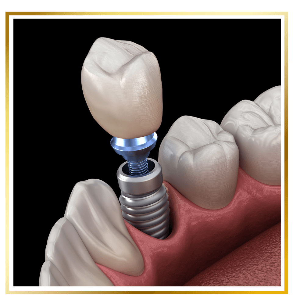 single dental implant