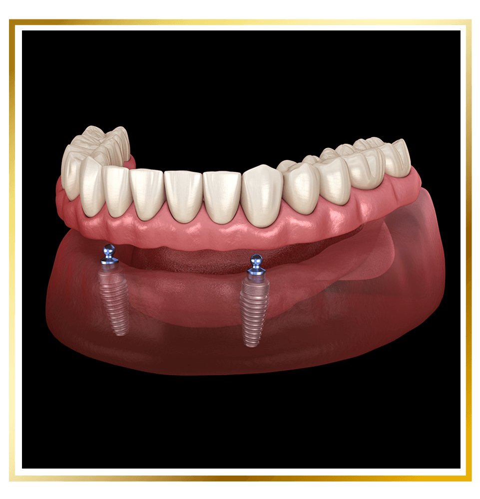 snap on denture