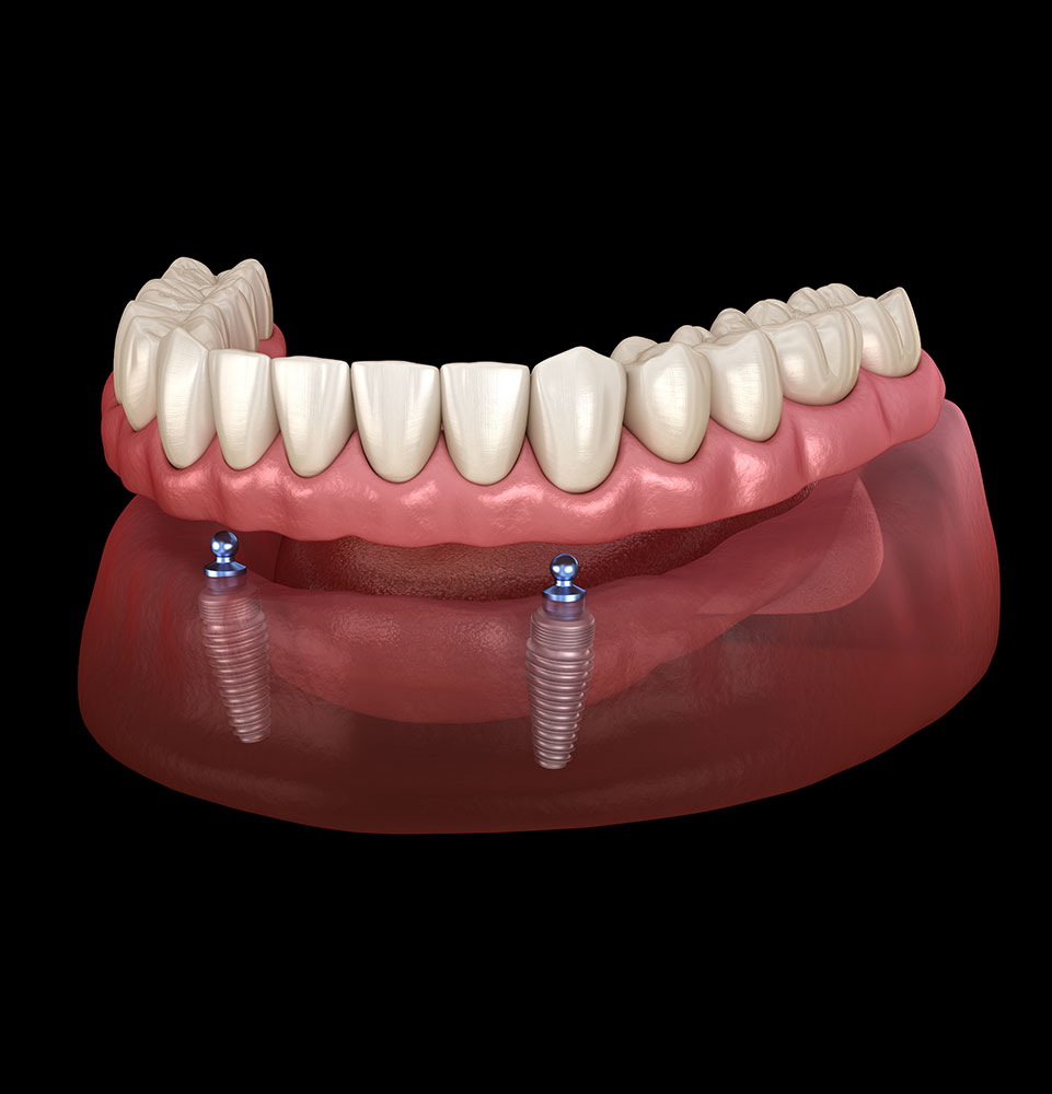 snap on dentures