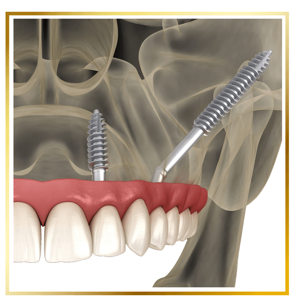 zygomatic