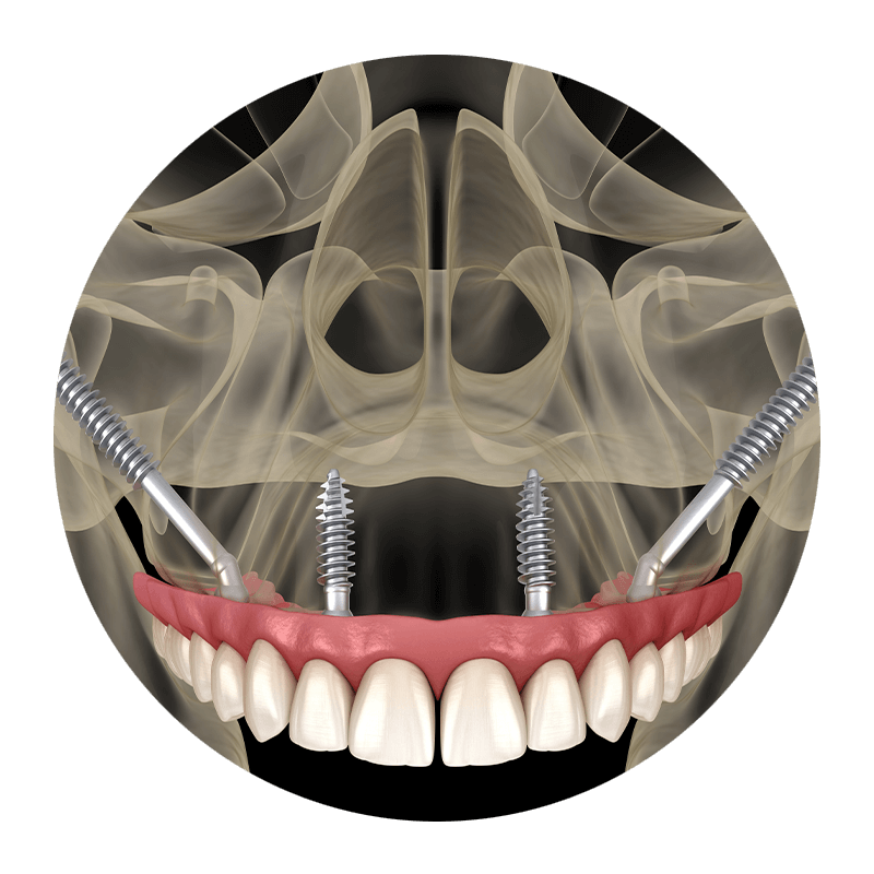 zygomatic front facing 3d