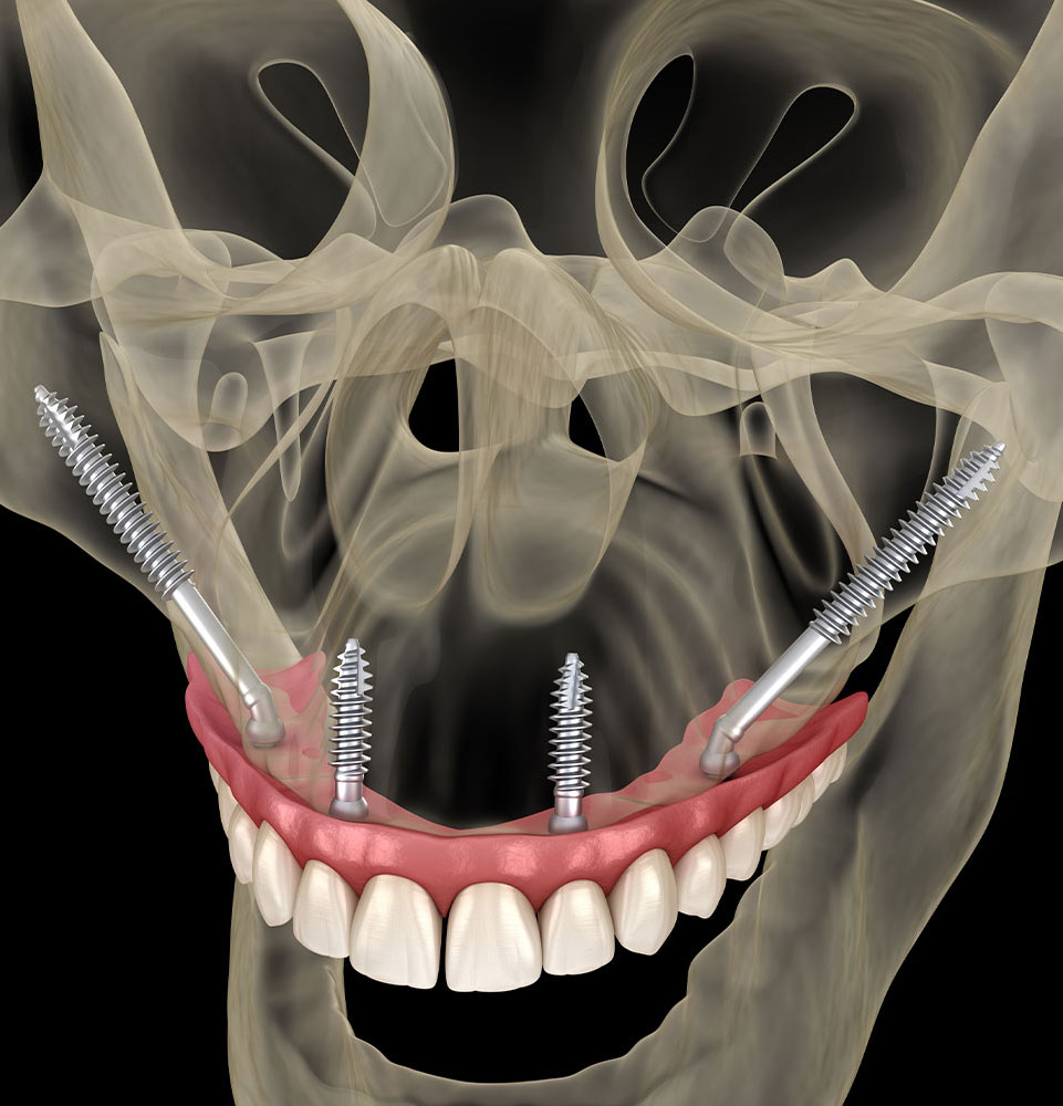 zygomatic implants 3d