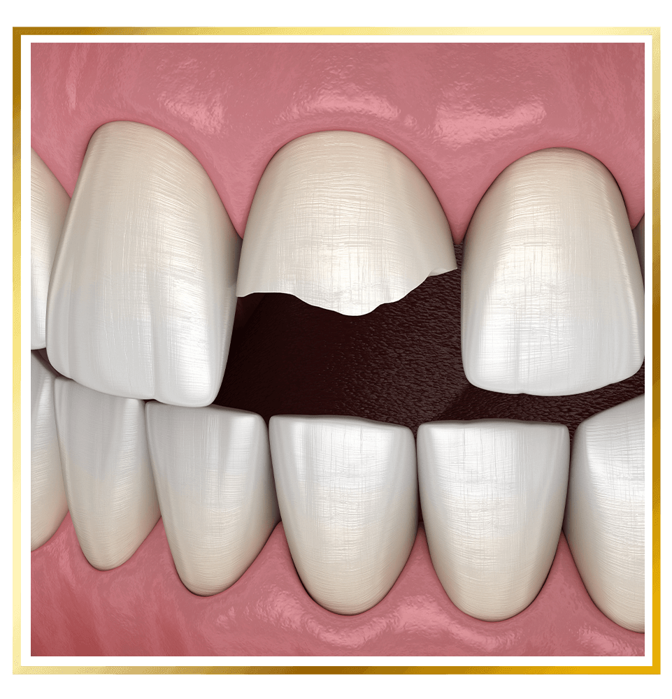 Broken Tooth