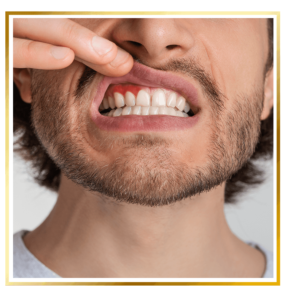 Gum Disease