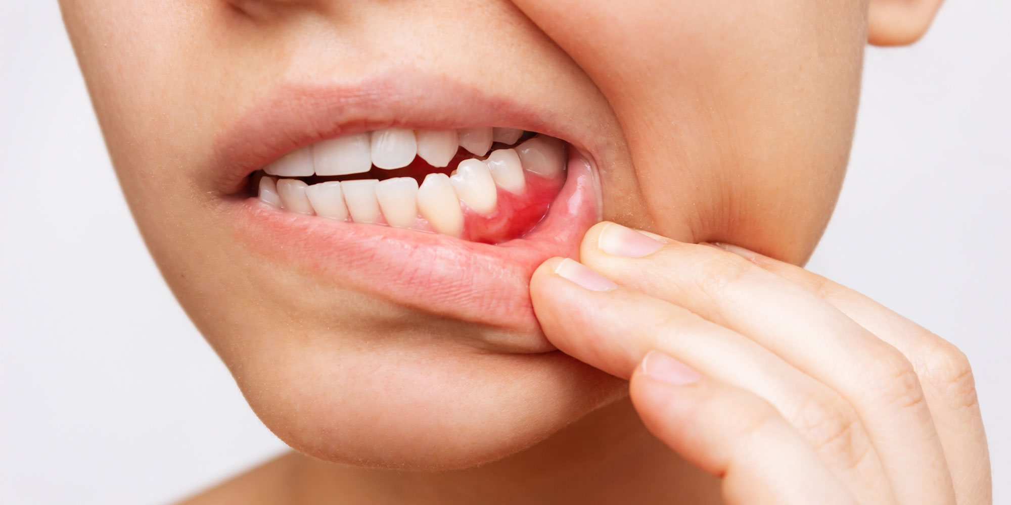 Gum Disease