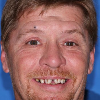 guided smile all on 4 5 6 case 9 before