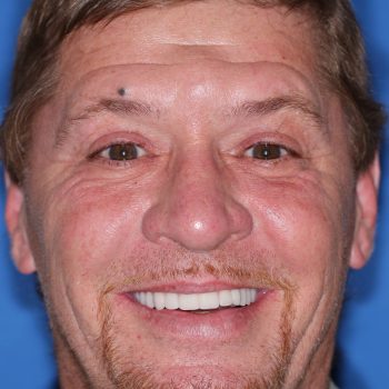 guided smile all on 4 5 6 case 9 after