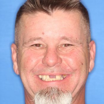 guided smile all on 4 5 6 case 1 beforee
