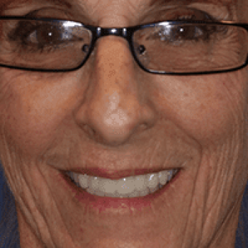 guided smile all on 4 5 6 case 4 after