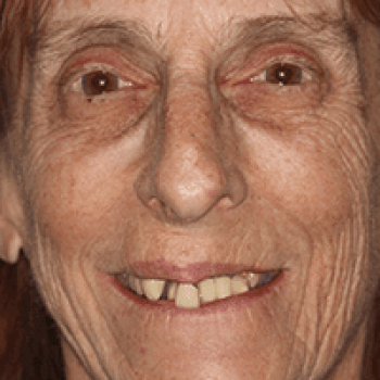 guided smile all on 4 5 6 case 4 before