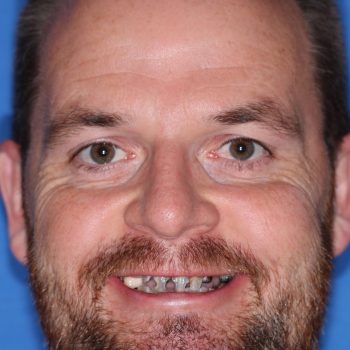 guided smile all on 4 5 6 case 13 before