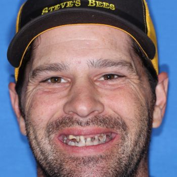 guided smile all on 4 5 6 case 8 before