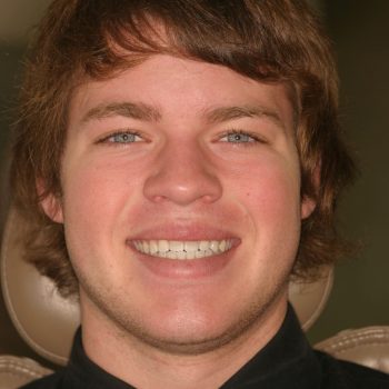 Veneers & Crowns case 1 before