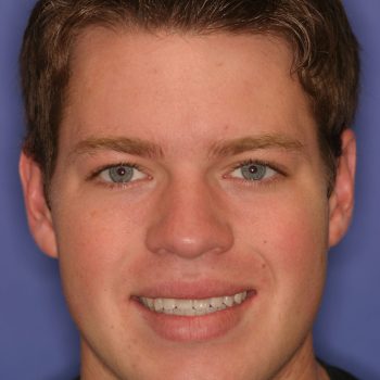 Veneers & Crowns case 2 after