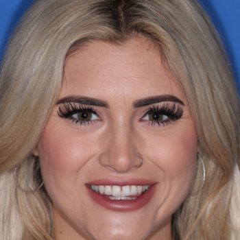 Veneers & Crowns case 4 before