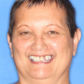 guided smile all on 4 5 6 case 10 before